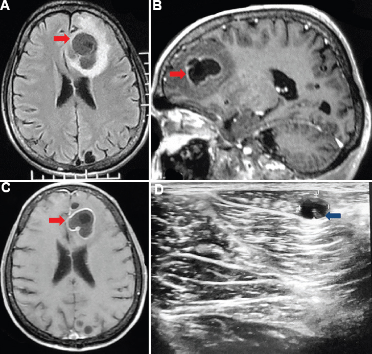(A) Cranial magnetic resonance imaging (fluid attenuated inversion recovery sequence) showing a large left frontal racemose neurocysticercal lesion (red arrow) with eccentric calcification and peri-focal oedema. (B and C) Sagittal and axial post-contrast T1-weighted images showing ring-enhancing racemose neurocysticercal lesion (red arrow) with few other small ring-enhancing cystic lesions in the left frontal and occipital lobe. (D) Ultrasound of the left thigh lesion showing a cystic lesion with central scolex (blue arrow).